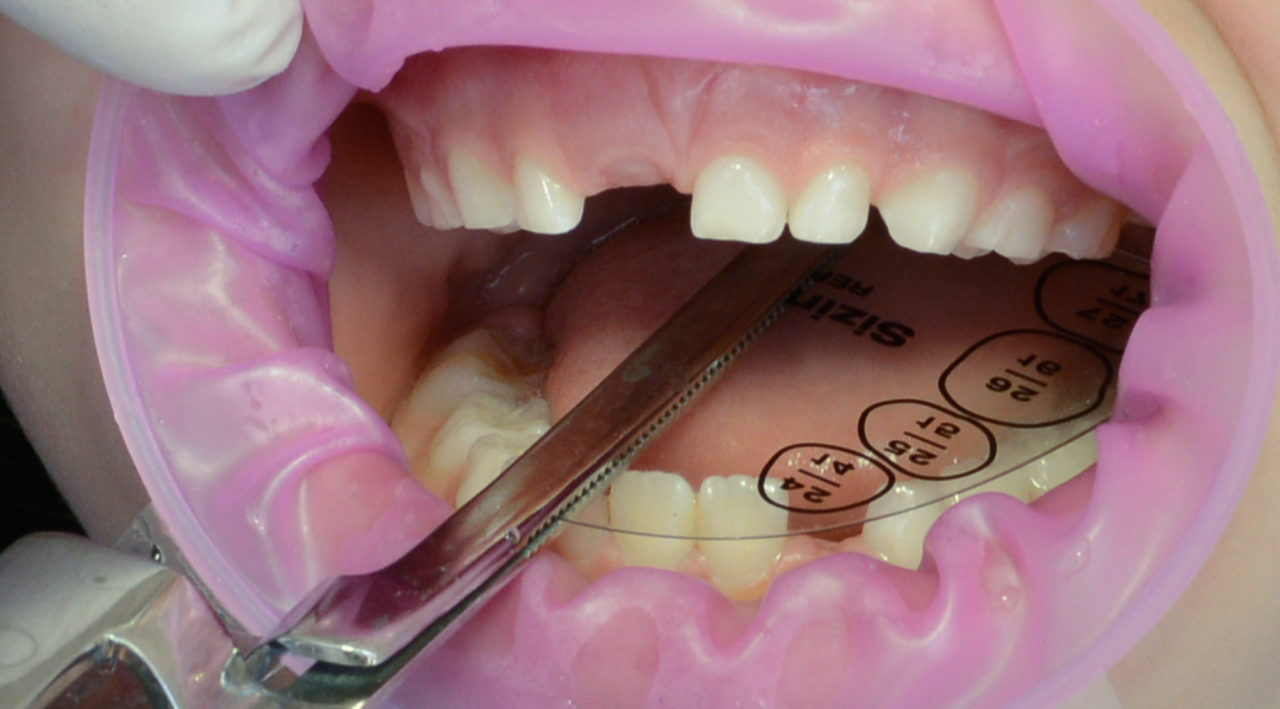 PEDIATRIC CROWN edelweiss dentistry products GmbH