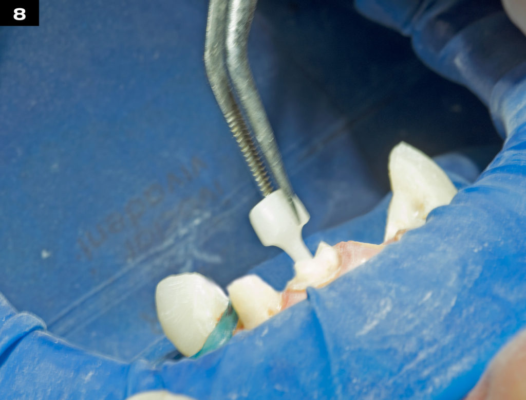 Post And Core Dental Book at Carol Jordon blog